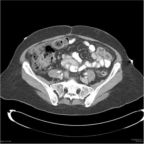 File:Acute pancreatitis (Radiopaedia 19136-19117 Axial C+ portal venous phase 31).jpg