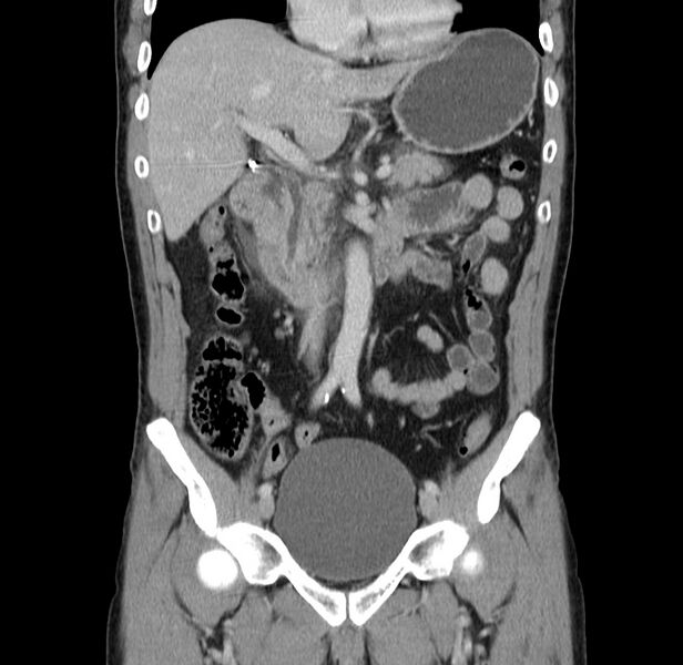 File:Acute pancreatitis (Radiopaedia 22572-22596 Coronal C+ portal venous phase 24).jpg