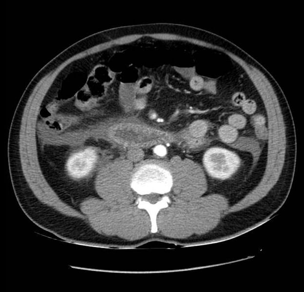 File:Acute pancreatitis - Balthazar E (Radiopaedia 23080-23110 Axial C+ arterial phase 37).jpg
