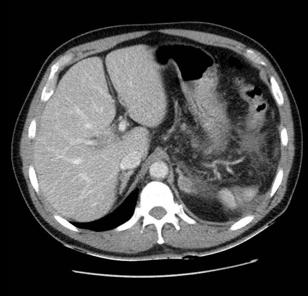 File:Acute pancreatitis - Balthazar E (Radiopaedia 23080-23110 Axial C+ portal venous phase 16).jpg
