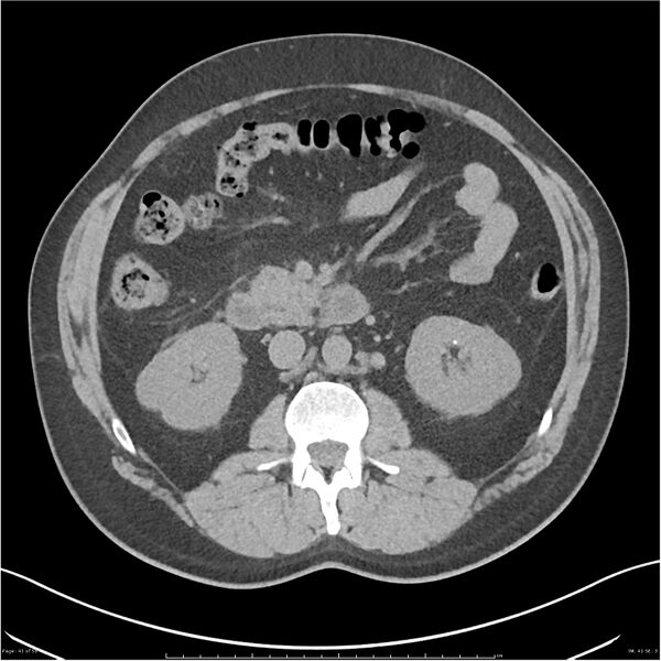 File:Acute pancreatitis - mild (Radiopaedia 27796-28033 Axial non-contrast 22).jpg
