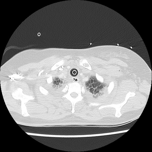 File:Acute pulmonary edema on CT (Radiopaedia 33582-34672 Axial lung window 3).jpg