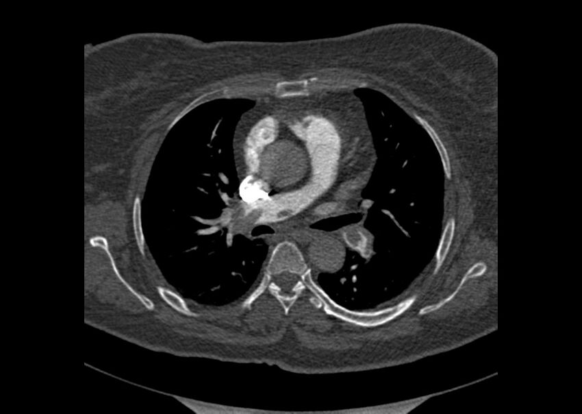 Acute pulmonary embolism (Radiopaedia 29938-30466 Axial C+ CTPA 62).jpg