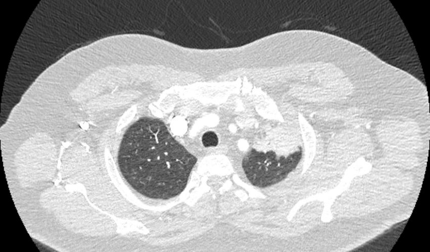 Acute pulmonary embolism with pulmonary infarcts (Radiopaedia 77688-89908 Axial lung window 8).jpg
