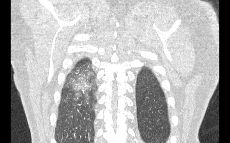 File:Acute pulmonary embolism with pulmonary infarcts (Radiopaedia 77688-89908 Coronal lung window 95).jpg