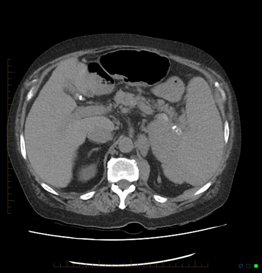 Acute renal failure post IV contrast injection- CT findings (Radiopaedia 47815-52557 Axial non-contrast 24).jpg