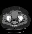Acute renal failure post IV contrast injection- CT findings (Radiopaedia 47815-52557 Axial non-contrast 73).jpg