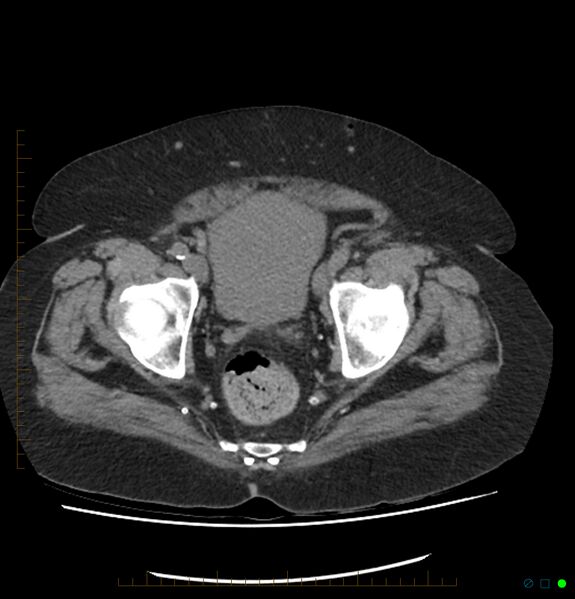 File:Acute renal failure post IV contrast injection- CT findings (Radiopaedia 47815-52557 Axial non-contrast 73).jpg