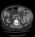 Acute renal failure post IV contrast injection- CT findings (Radiopaedia 47815-52559 Axial C+ portal venous phase 34).jpg