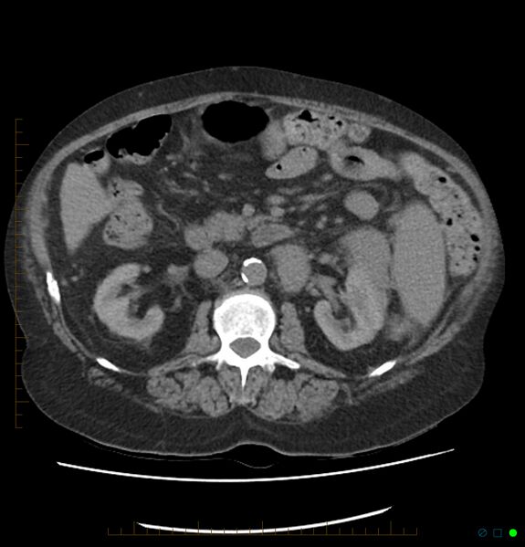 File:Acute renal failure post IV contrast injection- CT findings (Radiopaedia 47815-52559 Axial C+ portal venous phase 34).jpg