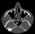 Acute sinusitis (Radiopaedia 23161-23215 Axial bone window 31).jpg
