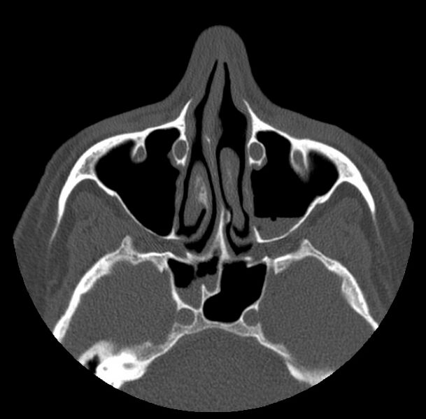 File:Acute sinusitis (Radiopaedia 23161-23215 Axial bone window 31).jpg
