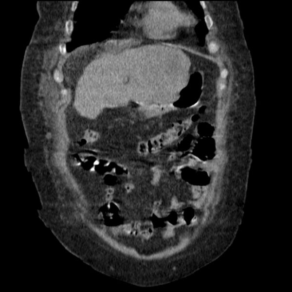 File:Acute tubular necrosis (Radiopaedia 28077-28334 D 23).jpg