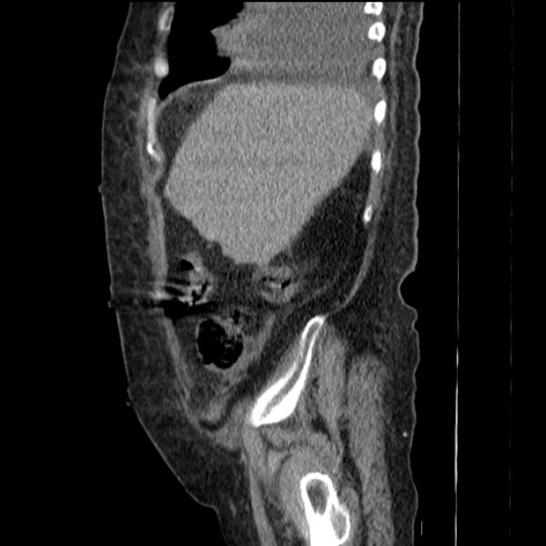 File:Acute tubular necrosis (Radiopaedia 28077-28334 H 21).jpg