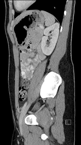 File:Acute uncomplicated appendicitis (Radiopaedia 61374-69304 Sagittal C+ portal venous phase 31).jpg