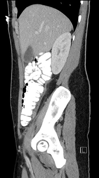 File:Acute uncomplicated appendicitis (Radiopaedia 61374-69304 Sagittal C+ portal venous phase 75).jpg