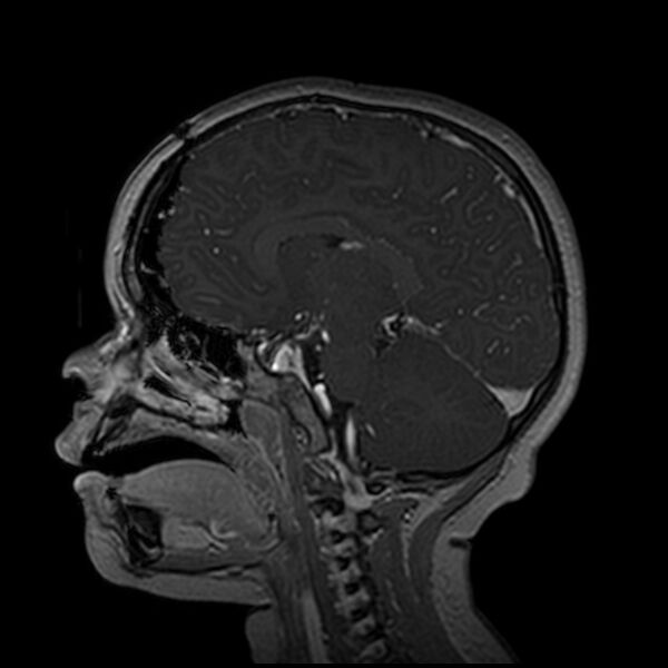 File:Adamantinomatous craniopharyngioma (Radiopaedia 77407-89529 H 54).jpg