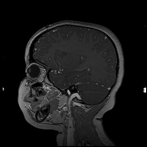 File:Adamantinomatous craniopharyngioma (Radiopaedia 77407-89529 H 85).jpg