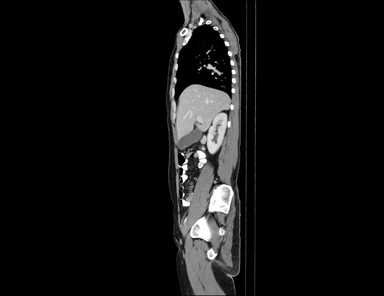 File:Addison disease (Radiopaedia 49318-54412 Sagittal C+ portal venous phase 47).jpg
