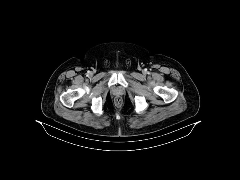 File:Adenocarcinoma of pancreas with hepatic metastasis (Radiopaedia 64332-73122 Axial C+ portal venous phase 102).jpg