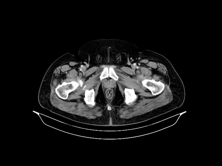 Adenocarcinoma of pancreas with hepatic metastasis (Radiopaedia 64332-73122 Axial C+ portal venous phase 102).jpg