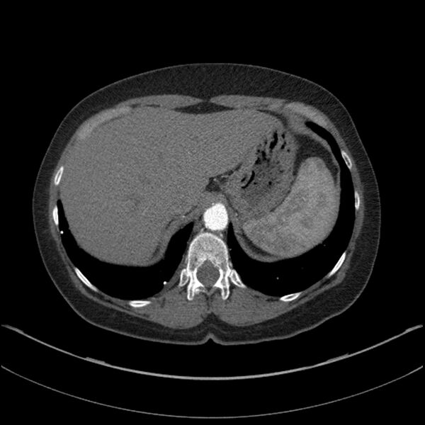 File:Adenocarcinoma of the lung (Radiopaedia 44205-47803 Axial C+ portal venous phase 75).jpg
