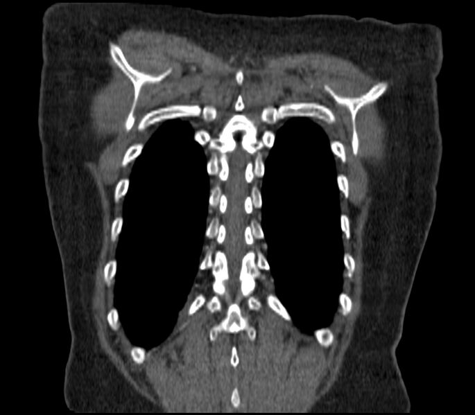 File:Adenocarcinoma of the lung (Radiopaedia 44205-47803 Coronal C+ portal venous phase 87).jpg