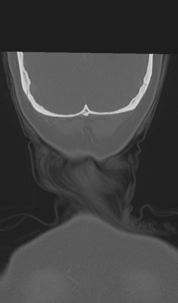 File:Adenoid cystic tumor of palate (Radiopaedia 46980-51518 Coronal bone window 59).png