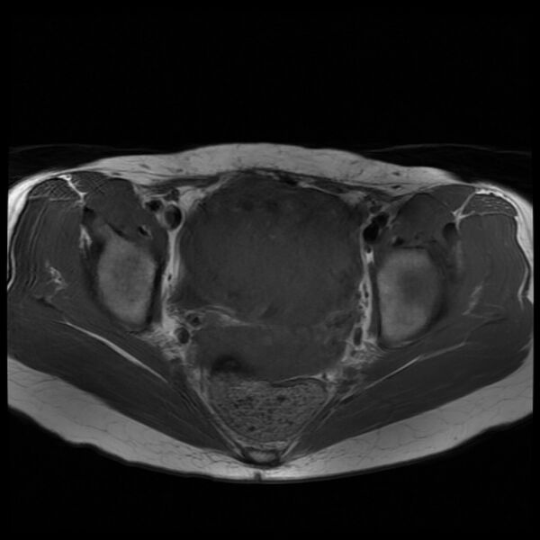 File:Adenomyosis on MRI (Radiopaedia 29328-29780 Axial T1 6).jpg