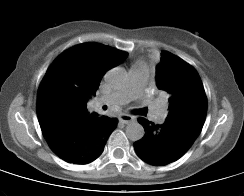 Adenosquamous lung carcinoma (Radiopaedia 22035-22030 non-contrast 30).jpg