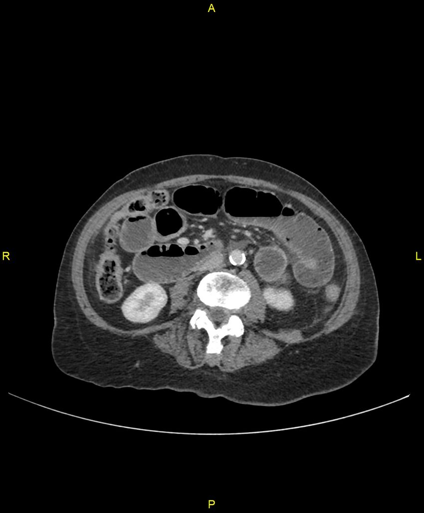 Adhesional small bowel obstruction (Radiopaedia 85402-101024 Axial C+ portal venous phase 146).jpg