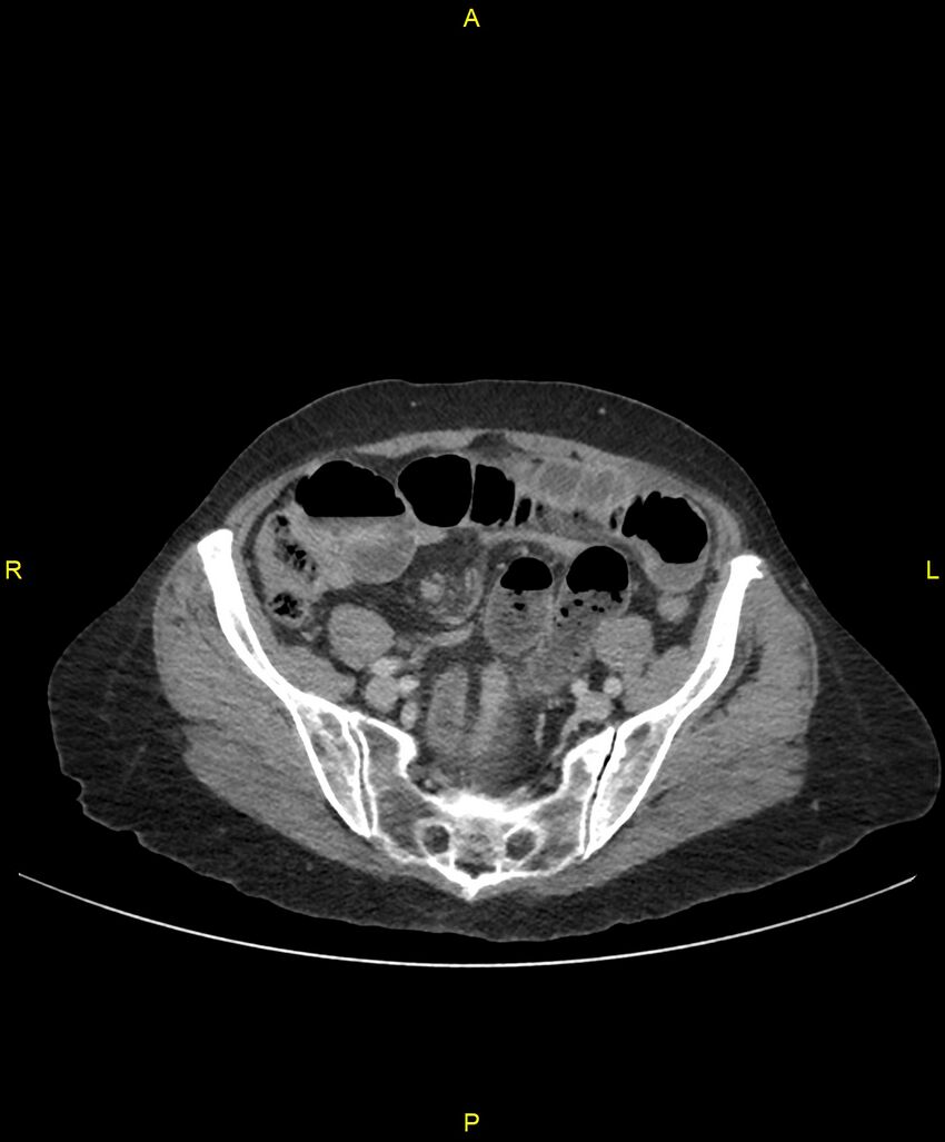 Adhesional small bowel obstruction (Radiopaedia 85402-101024 Axial C+ portal venous phase 214).jpg