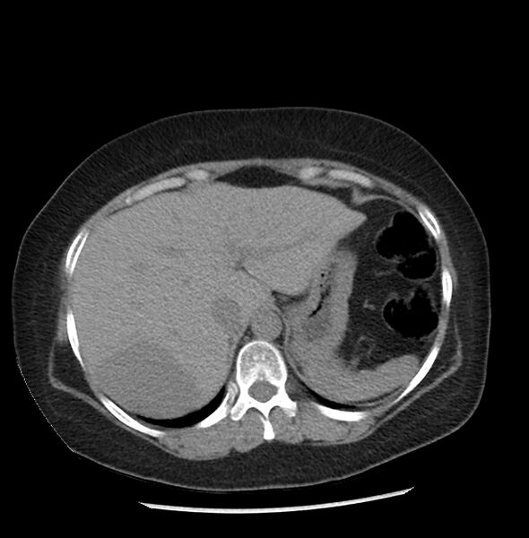 File:Adrenal cortical carcinoma with IVC invasion and thrombosis (Radiopaedia 34307-35597 Axial non-contrast 6).jpg