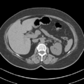 Adrenal hemangioma (Radiopaedia 33078-34103 Axial non-contrast 25).png