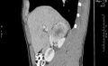 Adrenal pheochromocytoma (Radiopaedia 35133-36726 Sagittal C+ portal venous phase 13).jpg
