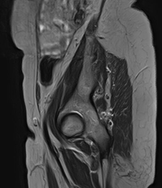 File:Adult granulosa cell tumor of the ovary (Radiopaedia 71581-81950 Sagittal T2 1).jpg
