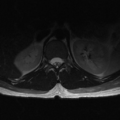 Aggressive vertebral hemangioma (Radiopaedia 39937-42404 Axial T2 4).png