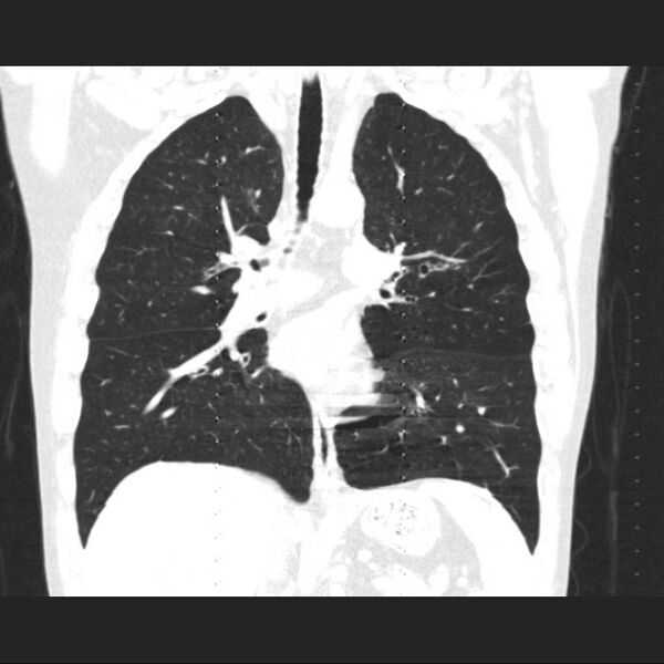 File:Allergic bronchopulmonary aspergillosis (Radiopaedia 21386-21320 Coronal lung window 9).jpg
