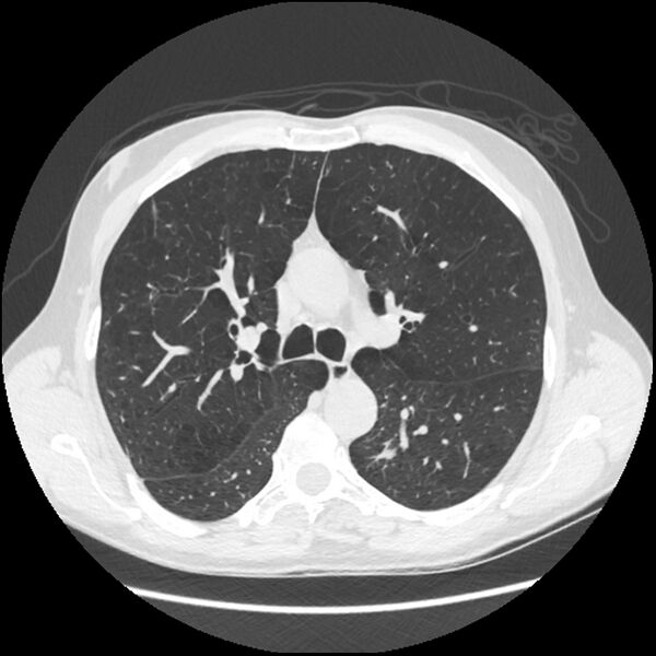 File:Alpha-1-antitrypsin deficiency (Radiopaedia 40993-43722 Axial lung window 89).jpg