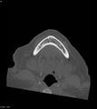 Ameloblastoma (Radiopaedia 18115-17901 Axial bone window 14).jpg