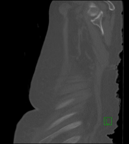 File:Amiodarone deposition in the liver (Radiopaedia 77587-89780 Sagittal bone window 13).jpg