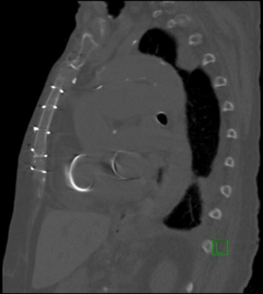 File:Amiodarone deposition in the liver (Radiopaedia 77587-89780 Sagittal bone window 43).jpg