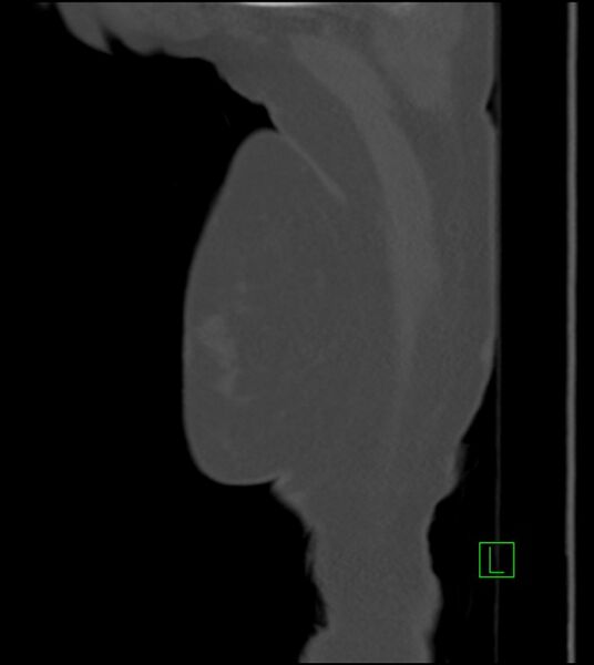 File:Amiodarone deposition in the liver (Radiopaedia 77587-89780 Sagittal bone window 98).jpg