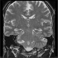 Amnestic syndrome secondary to hypoxic brain injury (Radiopaedia 24743-25004 F 6).jpg