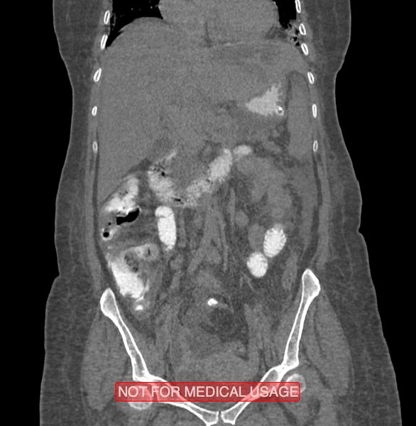 File:Amoebic enterocolitis with liver abscess (Radiopaedia 35100-36609 B 87).jpg