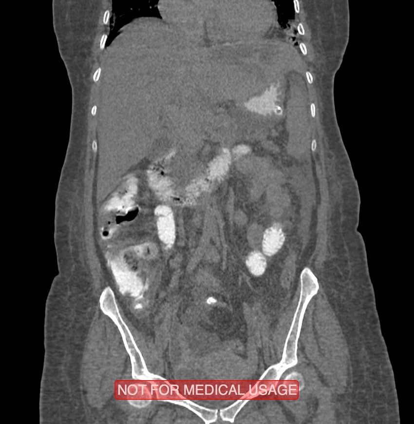 Amoebic enterocolitis with liver abscess (Radiopaedia 35100-36609 B 87).jpg