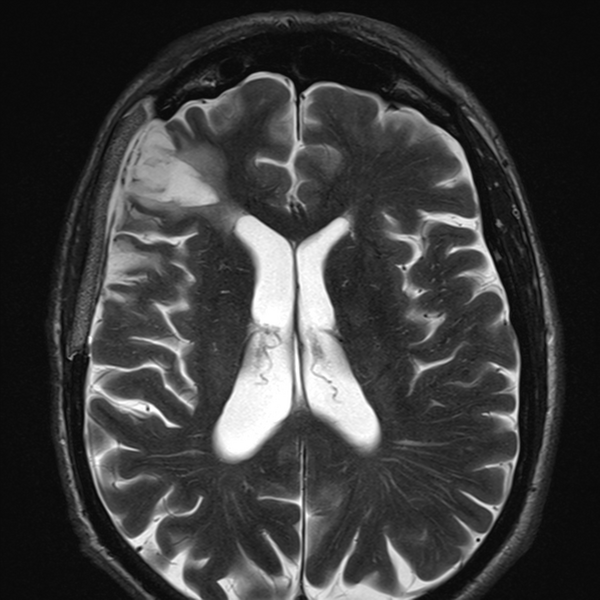 File:Anaplastic meningioma with recurrence (Radiopaedia 34452-35788 Axial T2 15).png