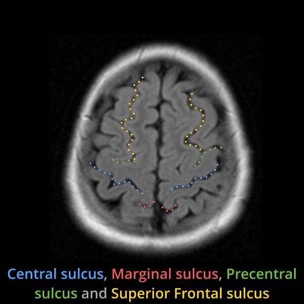 File:Anatomy- sulci of the brain (Radiopaedia 33834-34995 Central sulcus 9).jpg