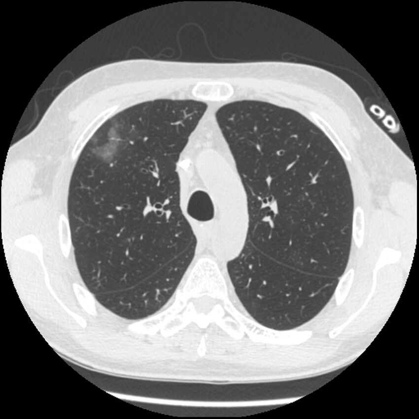Angioinvasive aspergillosis (Radiopaedia 43957-47466 Axial lung window 23).jpg