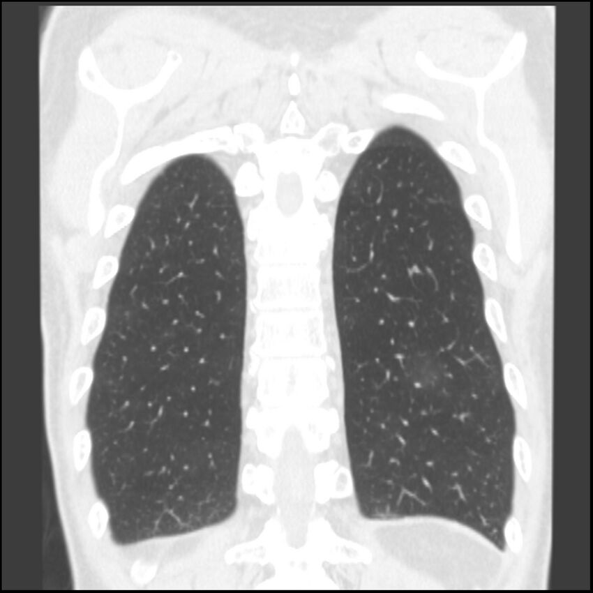 Angioinvasive aspergillosis (Radiopaedia 43957-47466 Coronal lung window 14).jpg
